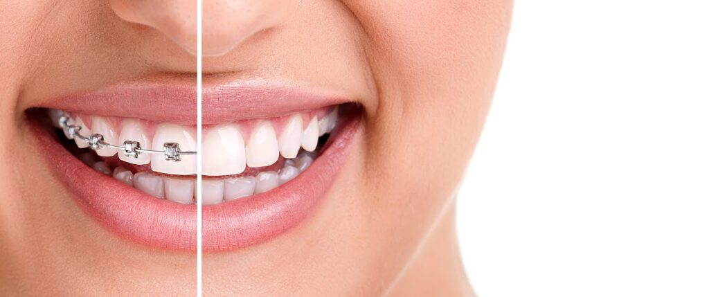Complete timeline for wearing your teeth braces