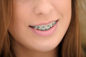 How long do you have to wear teeth braces